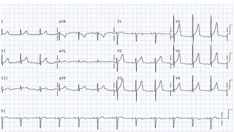 <p>10hr history of shortness of breath, sharp, retrosternal chest pain radiating to neck and left shoulder, worse with movement/swallowing. also 1 week hx fever, malaise, myalgia, diarrhea, cough, scratchy sore throat </p>