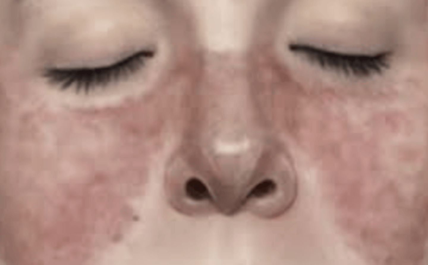 <p>Ofta hos yngre kvinnor, med ett akut förlopp där insjuknandet inkluderar muskel- och ledsmärtor, hudförändringar och uttalad trötthet. Typiskt ses en fjärilsformad lesion i ansiktet</p>