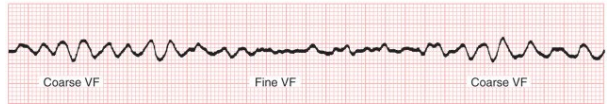 <p>What does this EKG show?</p>