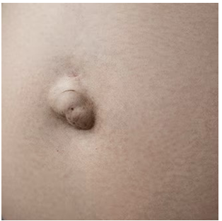 <p><span>How would you document the finding of this abdomen?</span></p><p></p>