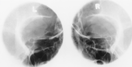 <p>What is this x-ray demonstrating?</p>