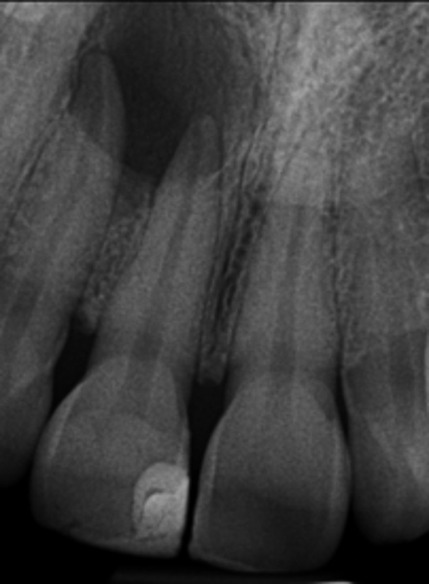 <p>How do you know this is NOT a Nasopalatine duct cyst?</p>
