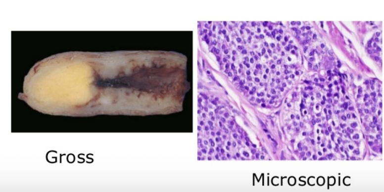 <p>most common tumor of the appendix, benign and usually found incidentally after surgery for acute appendicitis</p>