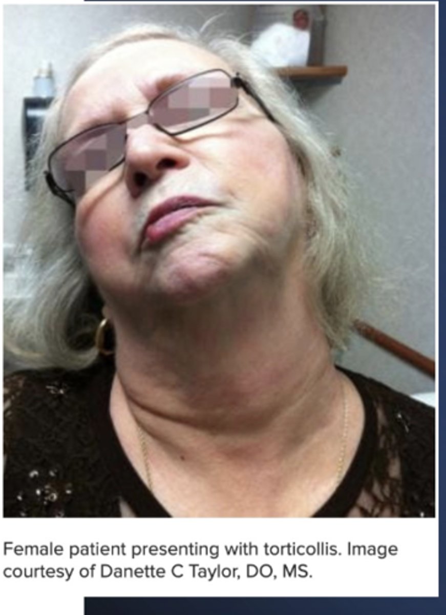 <p>Define Condition:</p><p>Head being rotated to one side --&gt; Abnormalities of motion of C1-2 Articulation</p><p>-Hx:</p><p>&gt; Trauma</p><p>&gt; Infex</p><p>&gt; Tumor</p><p>-Tx: OMT (if no signs of infex, tumor or C/Is)</p>
