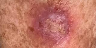 <p>Metastasizes to lymph nodes if not removed, early removal= good chance of cure, believed to be sun induced, comes from stratum spinosum</p>