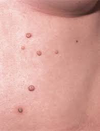<p>What lesion shape/configuration is this? What condition can cause this?</p>