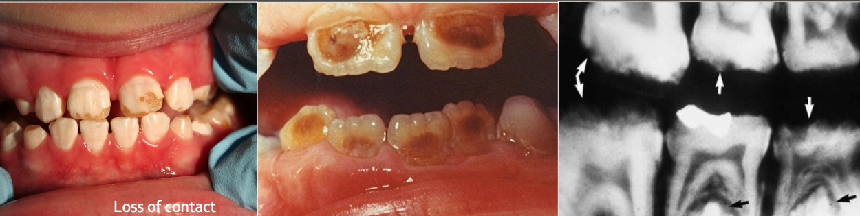 <ul><li><p>Autosomal dominant (AD), recessive (AR), X-linked</p></li><li><p>Both deciduous and permanent dentition are diffusely involved</p></li><li><p>Affects enamel, soft and thin, easily damaged and susceptible to decay</p></li><li><p>Dentin is exposed</p></li></ul><p></p>
