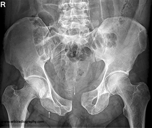 <ul><li><p><span>results in a “sprung” or "open book" pelvis which is a widening of the pubic symphysis and anterior sacroiliac joints</span></p></li><li><p><span>MOI = extreme force applied to the pelvis in an AP or PA direction</span></p></li><li><p><span>Surgical plating may be required if there are associated genitourinary injuries</span></p></li><li><p><span>Hemorrhage, genitourinary and rectal injuries</span></p></li></ul><p></p>