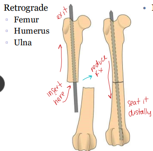 <p><span style="background-color: transparent;"><strong><span>Intramedullary Pins insertion </span></strong></span></p>
