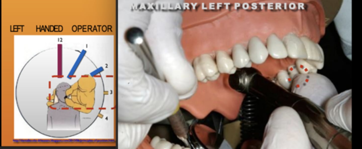 <p>Zone: 3</p><p>Vision: Direct</p><p>Patient's Head: Left</p><p>Fulcrum: Max Left Posterior (O)</p>