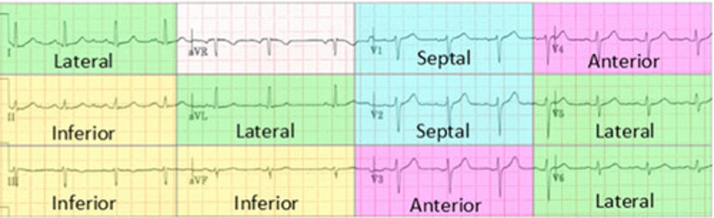 <p>It's gonna be a STEMI so know your lead locations</p>