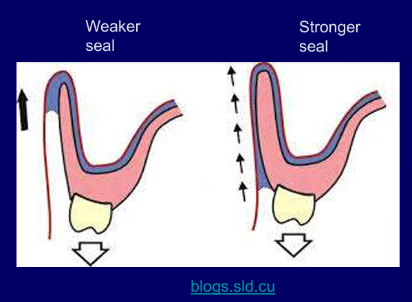 <p>A denture flange that is too thin does not work as well as one that fills the width of the sulcus</p><p>less likely to get air underneath, saliva layer receded so easier to get air there disrupting the seal</p>