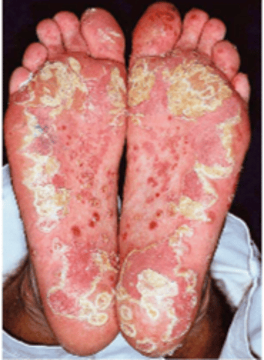 <p>Keratoderma Blennorrhagicum (10%)</p>