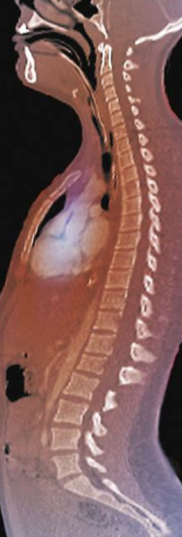 <ol><li><p><span style="background-color: transparent; font-family: &quot;Times New Roman&quot;, serif;"><span>Exaggerated cervical or lumbar curvature</span></span></p></li><li><p><span style="background-color: transparent; font-family: &quot;Times New Roman&quot;, serif;"><span>Happens when </span><u><span>a lot of weight</span></u><span> is </span><u><span>pushed</span></u><span> on vertebral</span></span></p><ol><li><p><span style="background-color: transparent; font-family: &quot;Times New Roman&quot;, serif;"><span>Ex. pregnancy</span></span></p></li></ol></li></ol><p></p>