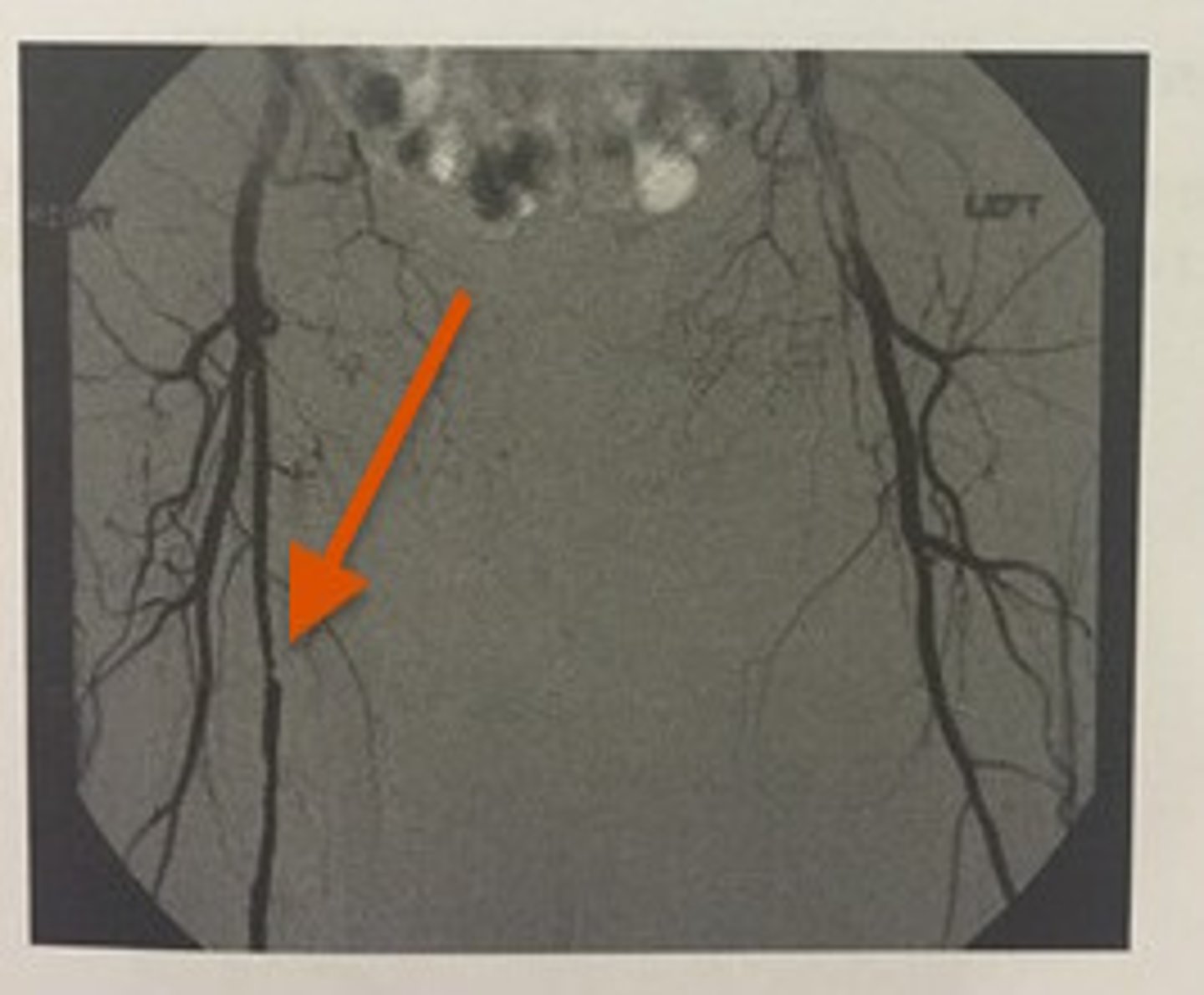 <p>471. (Peripheral arterial measurement techniques)</p><p>This angiogram of the lower extremities demonstrates:</p><p>a. severe left SFA stenosis</p><p>b. severe right CFA stenosis</p><p>c. severe right SFA stenosis</p><p>d. severe left CFA stenosis</p>