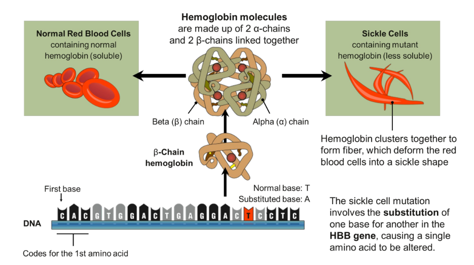 <ul><li><p>Incidence: Most common in people of African ancestry.</p></li><li><p>West Africans: 1% (10-45% are carriers)</p><ul><li><p>West Indians: 0.5%</p></li><li><p>Gene type: Autosomal recessive mutation (HBB) on chromosome 11 which results in the substitution of a single nucleotide in the HBB gene coding for the beta chain of hemoglobin.</p></li></ul></li><li><p>mutation responsible for causing sickle cell disease is a point substitution mutation (substitution of a valine for a glutamic acid in the beta-chain).</p></li></ul><p></p><p>Symptoms include the following:</p><ul><li><p>Pain, ranging from mild to severe, in the chest, joints, back, or abdomen</p></li><li><p>Swollen hands and feet</p></li><li><p>Jaundice</p></li><li><p>Repeated infections, particularly pneumonia and meningitis</p></li><li><p>Kidney failure</p></li><li><p>Gallstones (at an early age)</p></li><li><p>Strokes (at an early age)</p></li><li><p>Anaemia</p></li></ul>