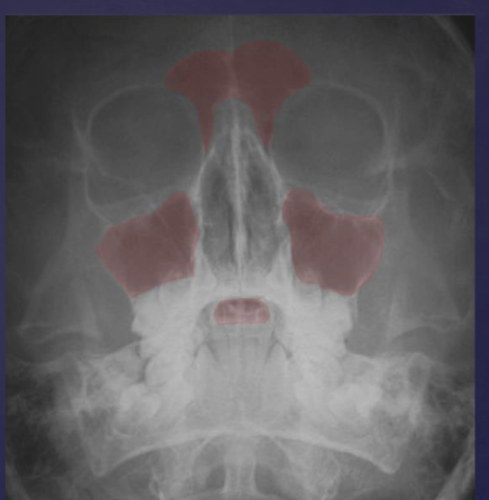 <ul><li><p><strong>evaluating maxillary, frontal, ethmoid sinuses</strong></p></li><li><p>orbit</p></li><li><p>zygomaticofrontal suture</p></li><li><p>nasal cavity</p></li></ul><p></p>