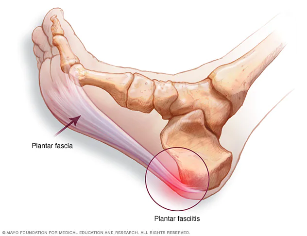 Inflammation of the plantar fascia 