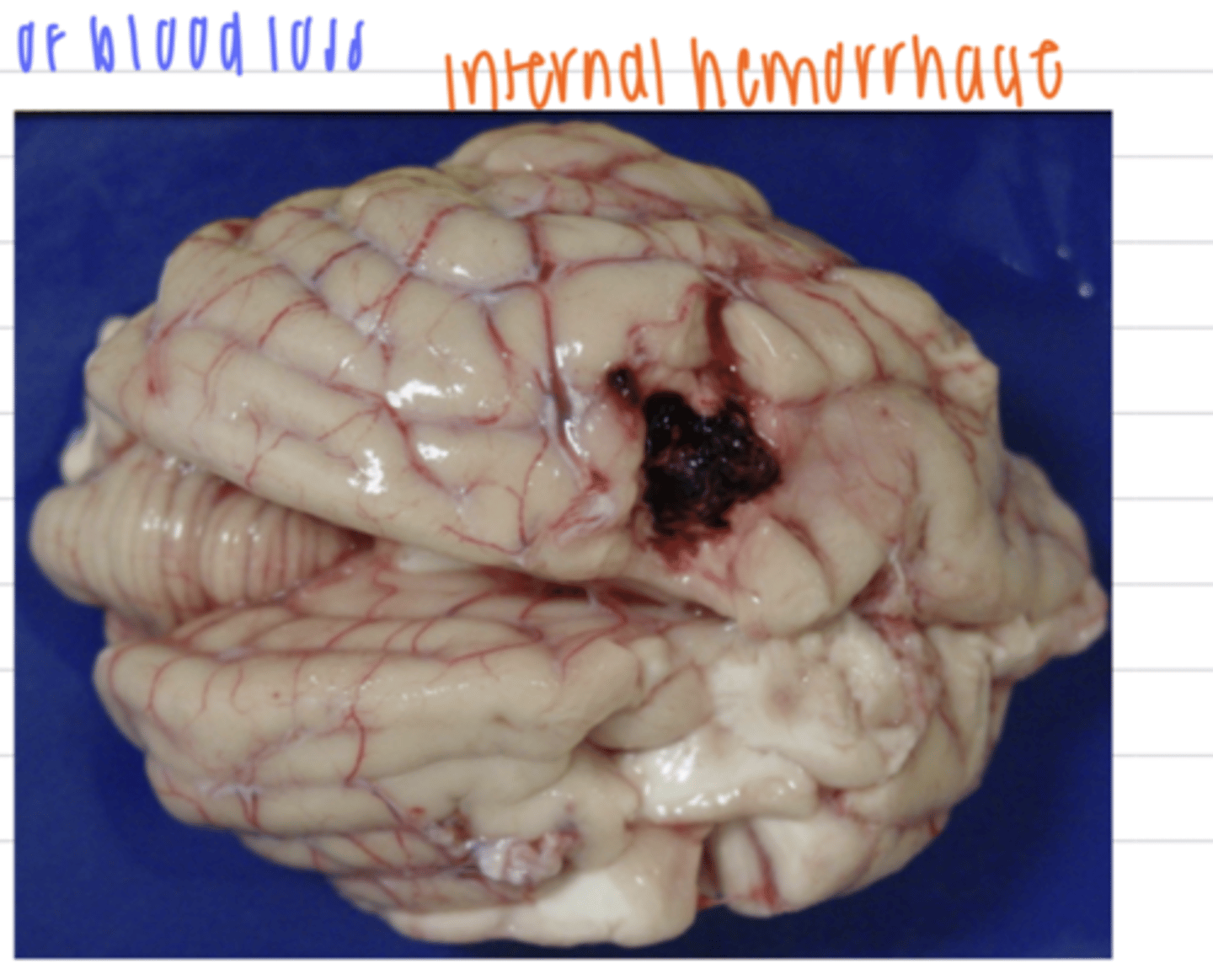 <p>internal hemorrhages affect the brain parenchyma</p><p>intracraneal extraencephalic hemorrhage puts pressure on the brain tissue</p>