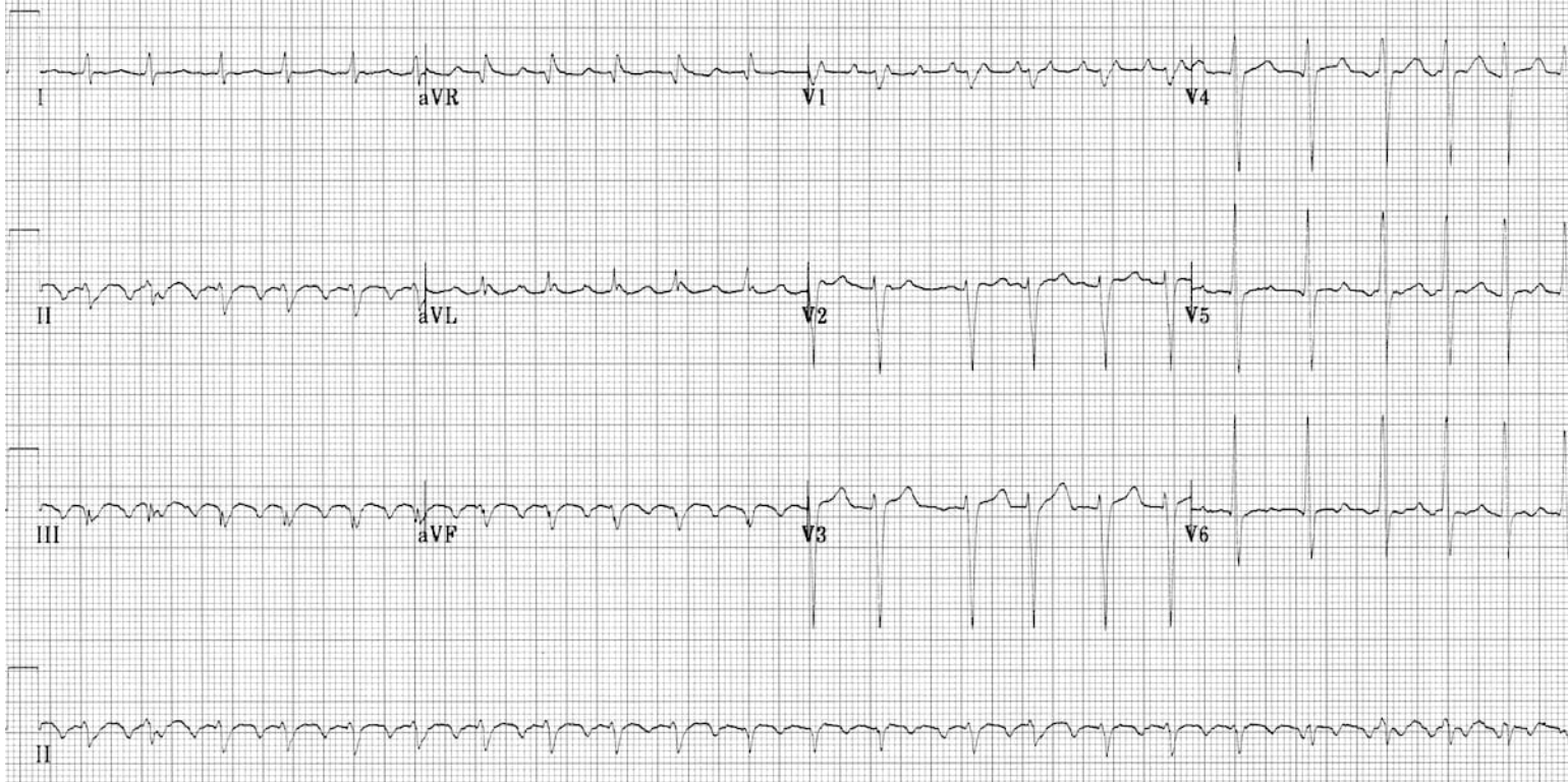 <p>How do you control the rate of atrial flutter?</p>