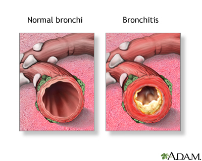 bronchitis