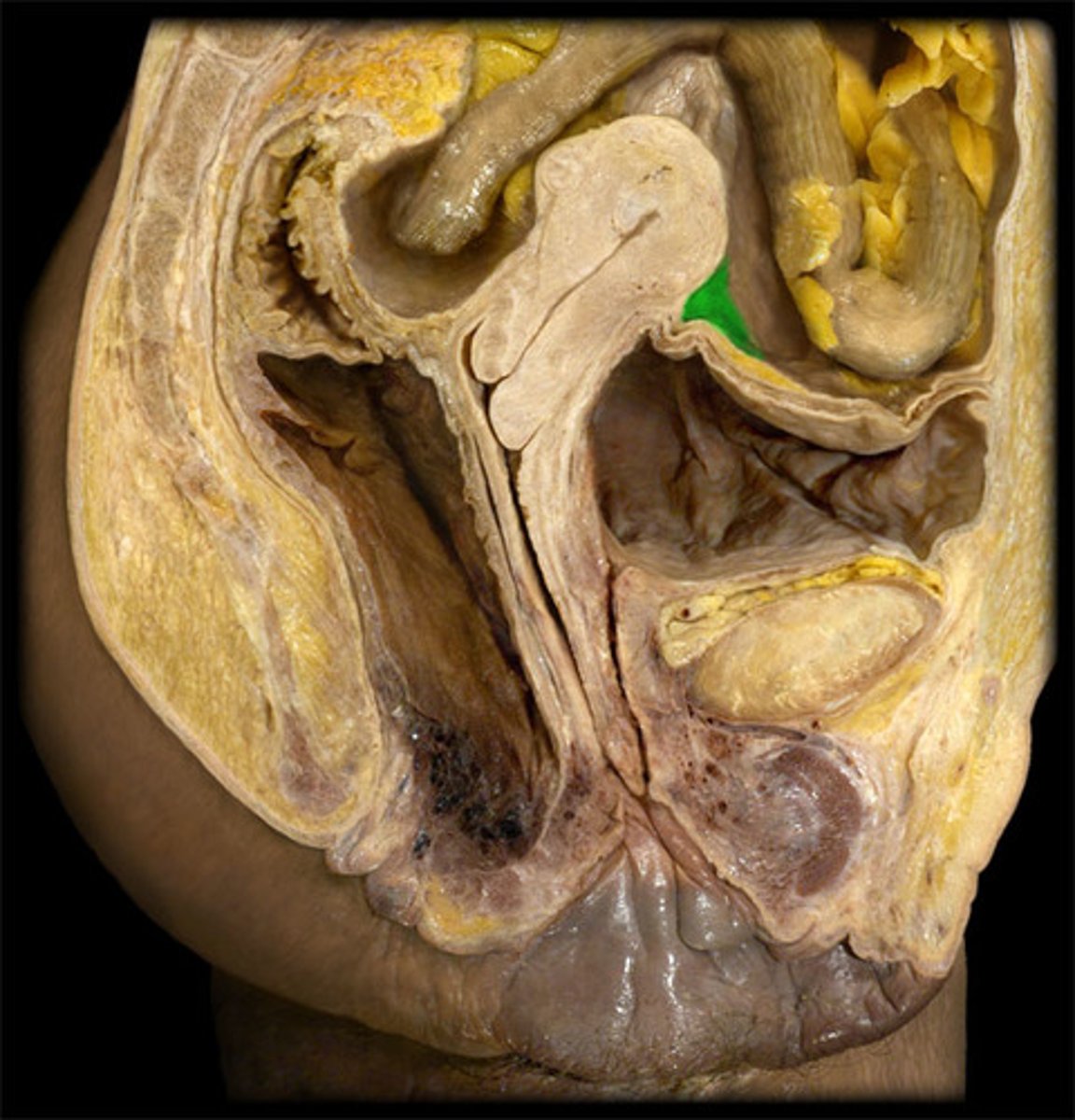 <p>between bladder and uterus</p>