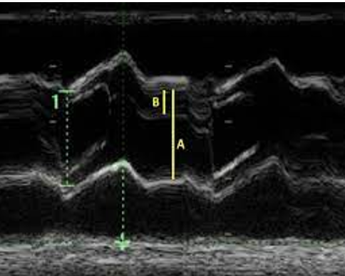 <p>eccentric line closure</p>