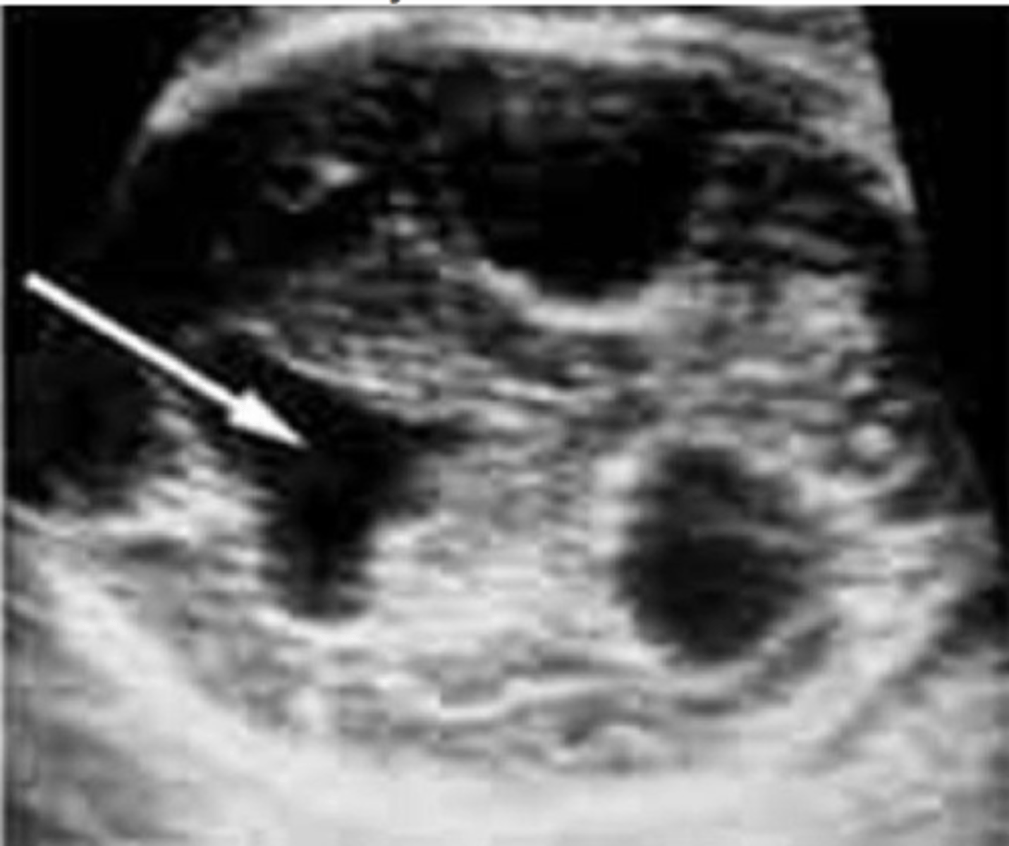 <p>Complete division of ventricles</p><p>Corpus callosum is present</p>