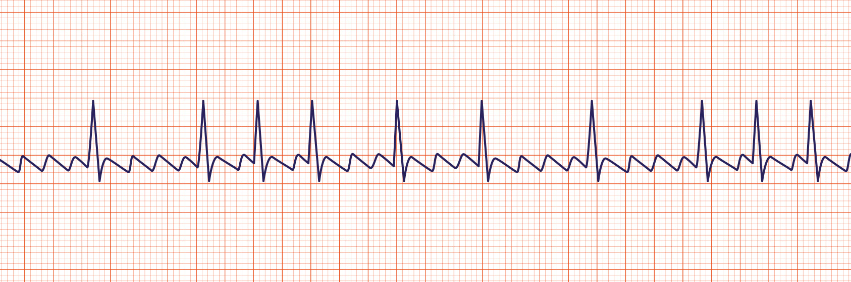 <p><span>Atrial flutter is a supraventricular arrhythmia that is characterized by a “saw-toothed” flutter appearance on the ECG that represents multiple P waves for each QRS complex.</span></p>