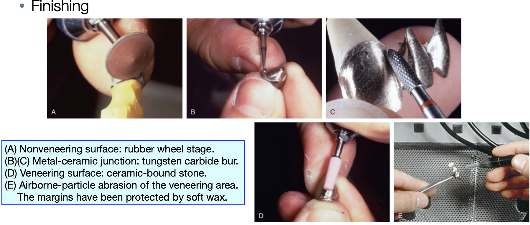 <ol><li><p>(A) nonveneering surface: rubber wheel stage&nbsp;</p></li><li><p>(B) (C) metal ceramic junction: tungsten carbide bur&nbsp;</p></li><li><p>(D) veneering surface: ceramic bound stone&nbsp;</p></li><li><p>(E) airborne-particle abrasion of the veneering area</p></li></ol><p></p>