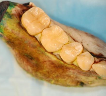 <p>Where would you find ossifying fibroma?</p>