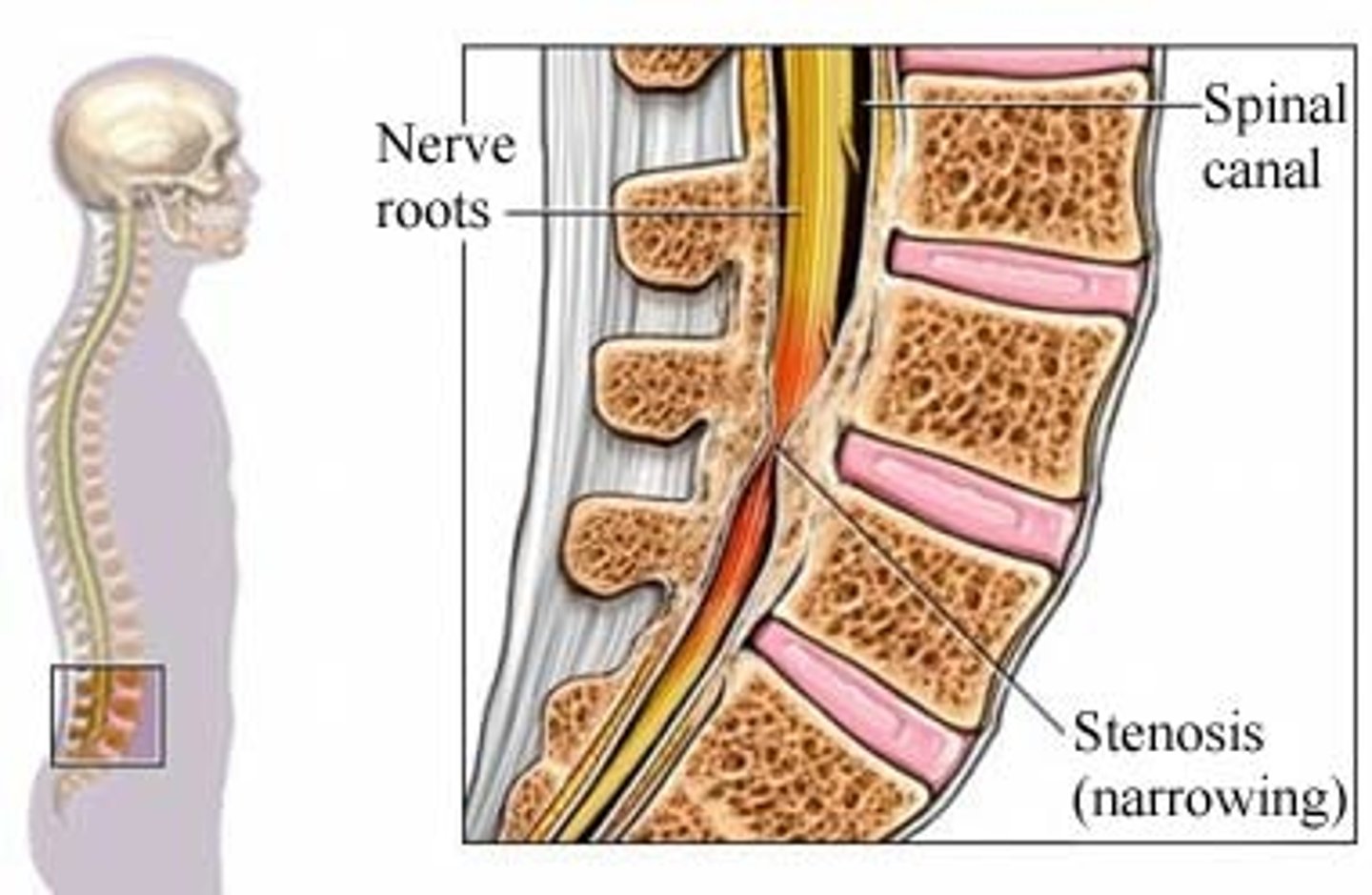 <p>narrowing of the spinal canal with compression of nerve roots</p>