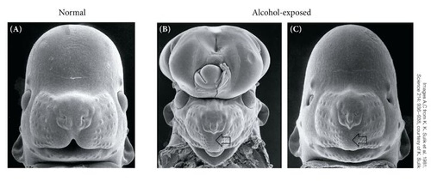 <p>A condition resulting from alcohol exposure during pregnancy, leading to developmental anomalies.</p>