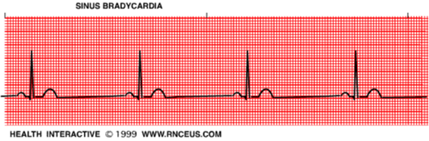 <p>slow rate, normal rhythm</p>