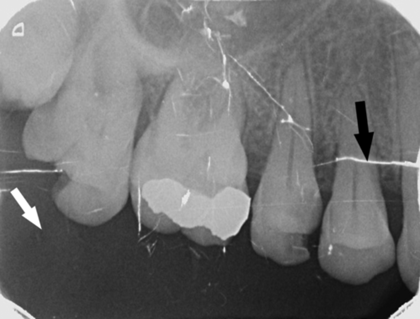 <p>-Film emulsion is scratched from the base</p><p>-Damaged pixel from the digital sensors and phosphor plate</p><p>-Scratched film due to careless handling of the film</p>