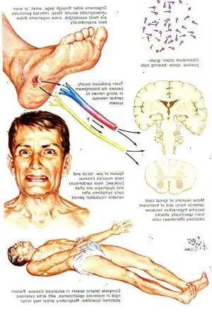 Tetanus