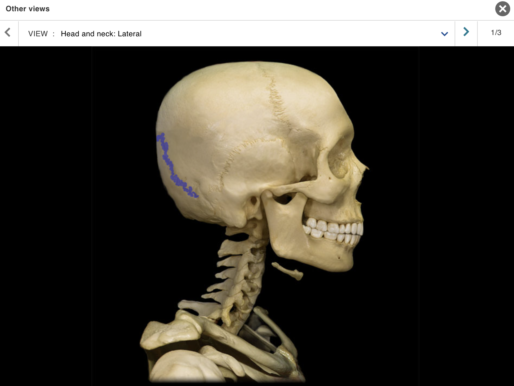 <p>Location:</p><p class="p1">• Skull (posterior)</p><p class="p1">Description:</p><p class="p1">• Joint between parietal and occipital bones</p>