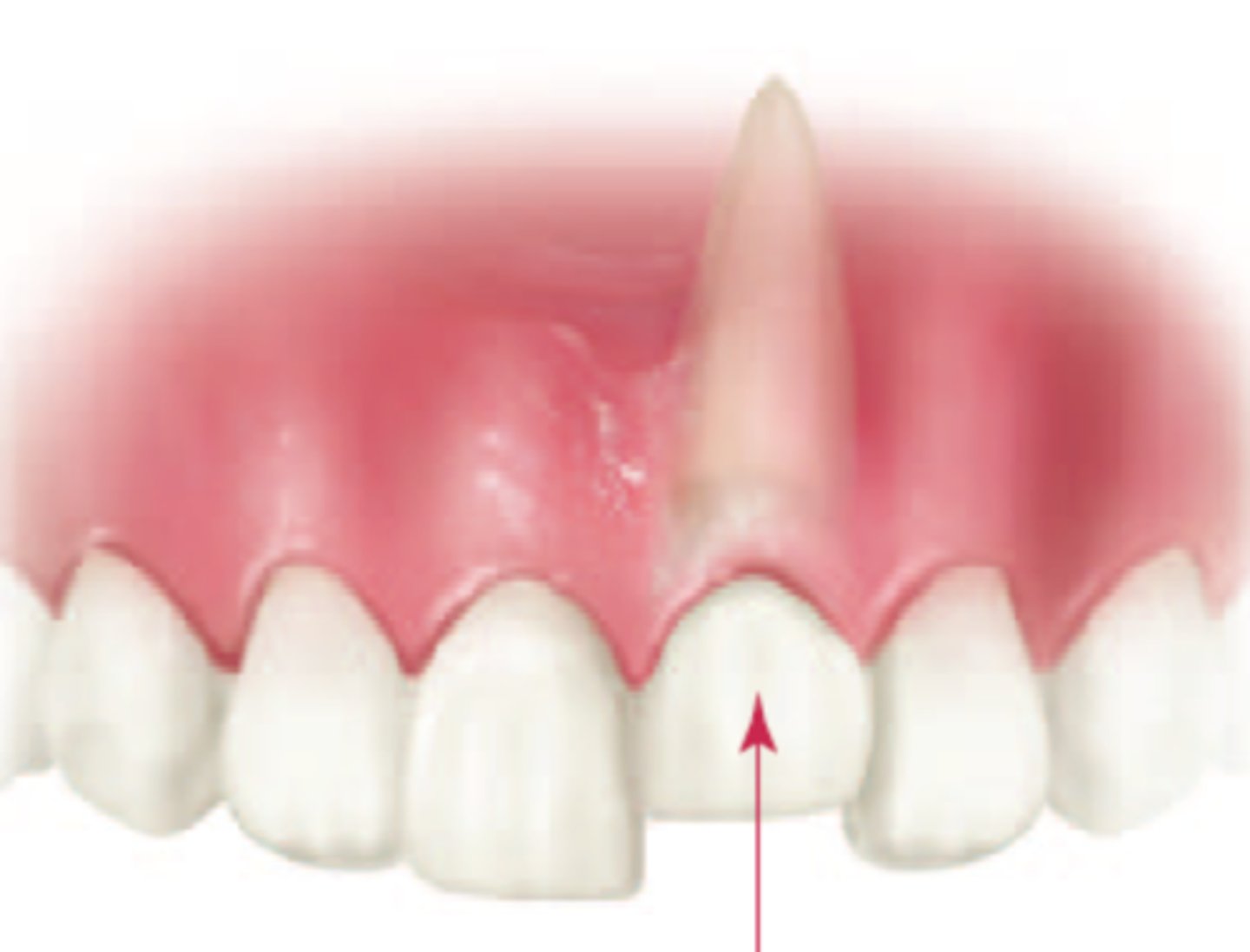 <p>tooth has almost or completely disappeared into the socket and can be palpated labially</p>