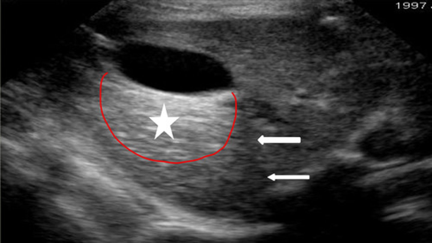 <p>does the star or arrows show distal enhancement or refraction?</p>