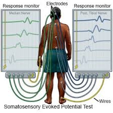 <ul><li><p><span>records time it takes for impulse to reach brain</span></p></li><li><p><strong><span>rules out MS, acoustic neuroma, etc</span></strong></p></li><li><p><span>are recorded from the presentation of a stimulus. They can be used to determine how quickly and completely nerve signals reach the brain assisting in the diagnosis of several medications (i.e. MS)</span></p></li></ul><p></p>
