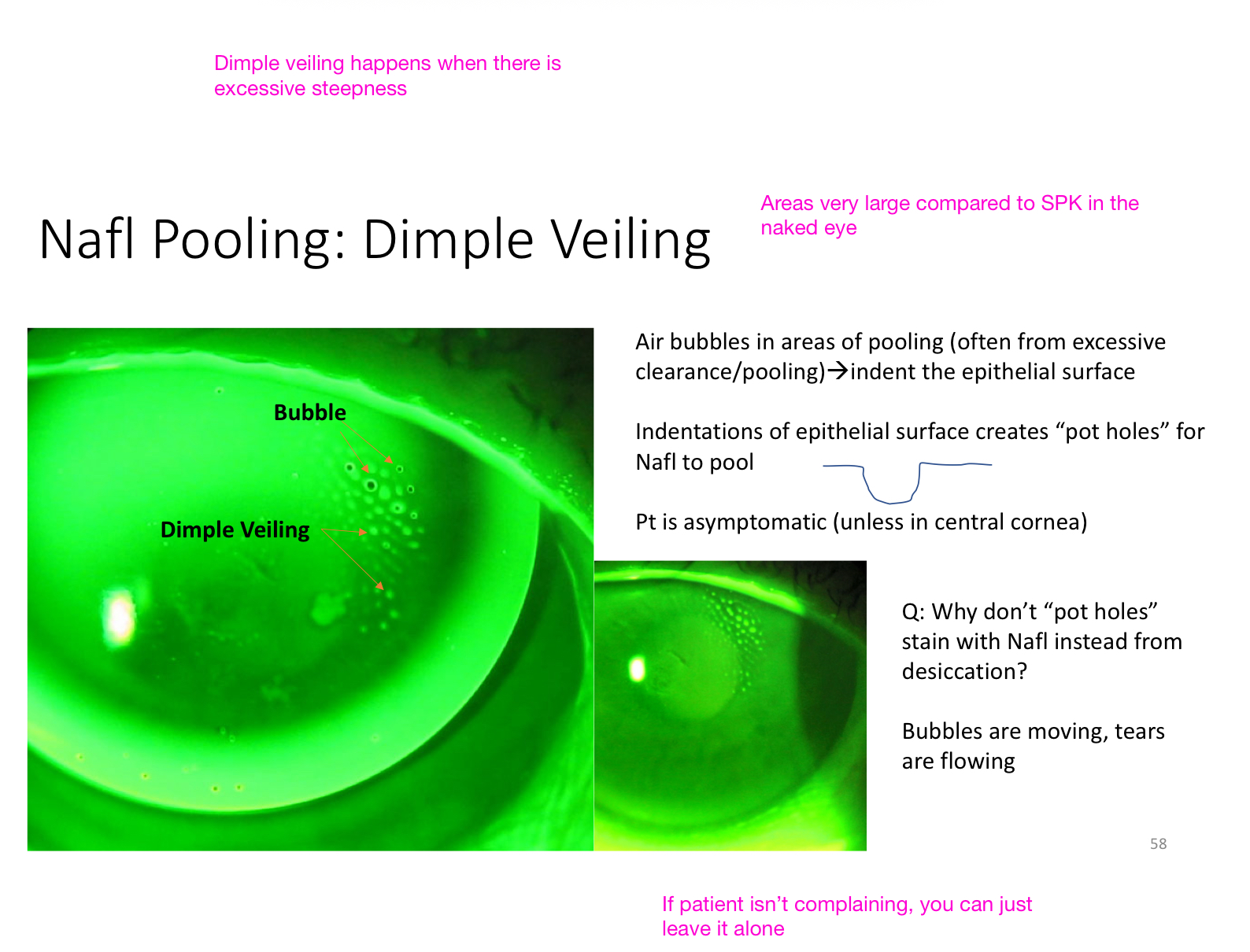 <ul><li><p><strong>Dimple veiling</strong> happens where there is excessive steepness </p><ul><li><p>Result of poor tear exchange under the GP, leading to entrapment of bubbles of carbon dioxide under the central curvature of the lens </p></li></ul></li><li><p><strong>Flatten: </strong></p><ul><li><p><span style="color: red;"><strong>Treatment of choice is to decrease the diameter of the optic zone </strong></span></p><ul><li><p>Allows for better tear flow that may have been impeded by a tight mid-peripheral junction of the optic zone and the intermediate and peripheral curvatures of the contact lens </p></li></ul></li></ul></li></ul><p></p>
