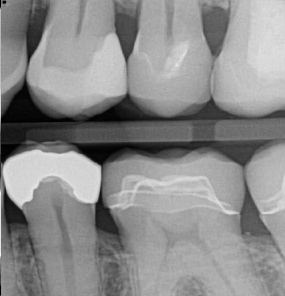 <p>What restoration is the molar</p>