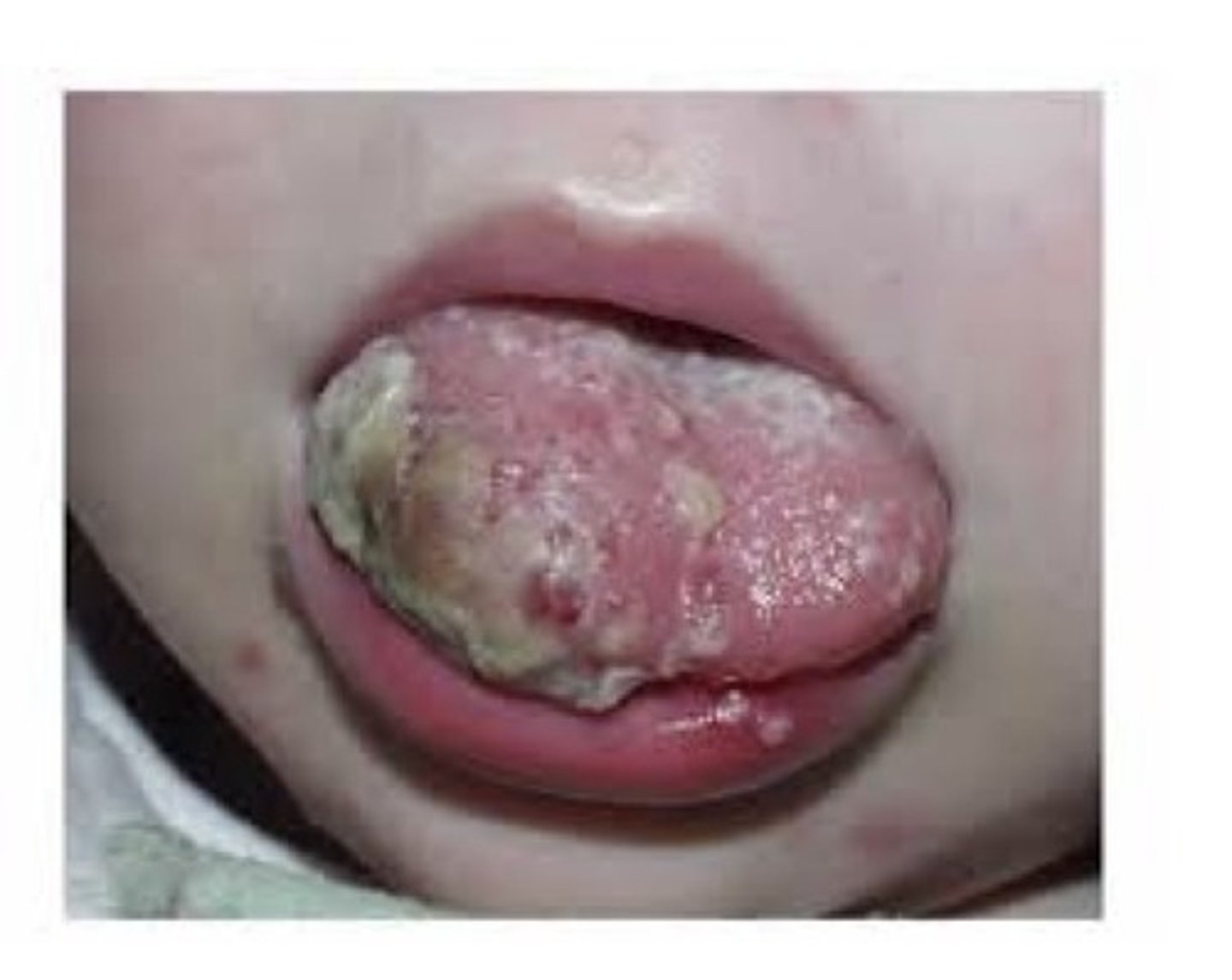 <p>A benign tumour of lymphatic vessels. Most are present at birth, half arise in the head and neck area. Intraorally, the most common location is the tongue, where it is an ill-defined mass with a pebbly surface. A cystic —————————— in the neck is called a cystic hygroma.</p>