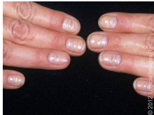 <p><strong>Clinical Manifestations of Paronychia</strong></p><p>-Acute: ________, ___, warm, swollen area around the proximal/lateral nail folds at the _______. +/- abscess</p><p>-Chronic: initially appears as ________ tender, boggy nail fold +/- abscess. Later appears as a retracted nail fold, thickened nail plate with _____ lines and discoloration</p><p>-Occasional _________ of nail bed or separation of nail fold from nail plate</p><p>-Purulent __________ or material at the nail margin</p><p>-If left untreated, it can progress to _______</p>