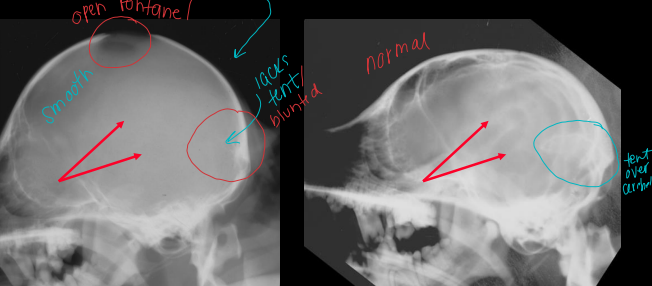 <p>Hydrocephalus</p>