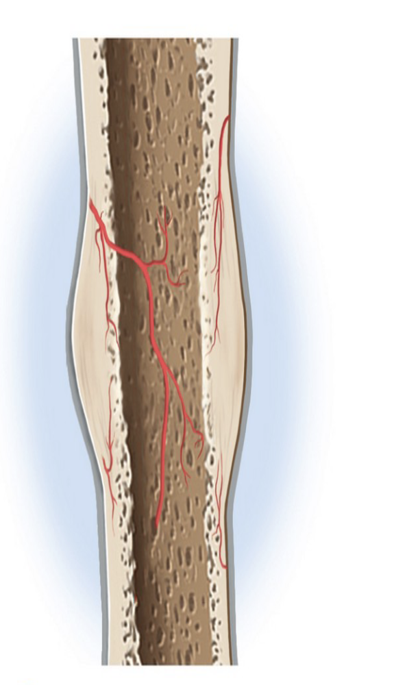 <ul><li><p><strong>Osteoclasts </strong>remove small bone fragments</p></li><li><p><strong>Osteoblasts </strong>lay down <strong>spongy bone </strong>filling gaps and preventing the bone from healing shorter</p></li><li><p>Over time, spongy bone becomes <strong>compact bone </strong>again</p></li></ul><p></p>