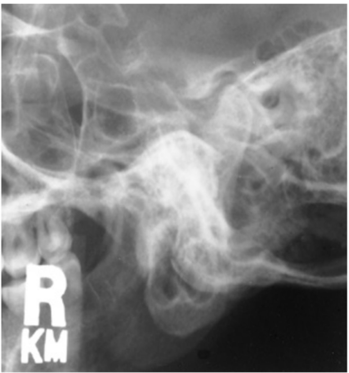 <p>-Position: Correctly positioned images demonstrate TMJ closest to IR clearly, without superimposition of opposite TMJ (15° rotation prevents superimposition). </p><p>• TMJ of interest is not superimposed by cervical spine</p>