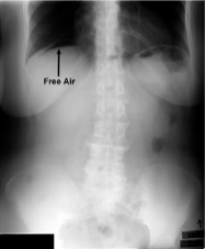 <p>presence of air in peritoneal cavity</p>