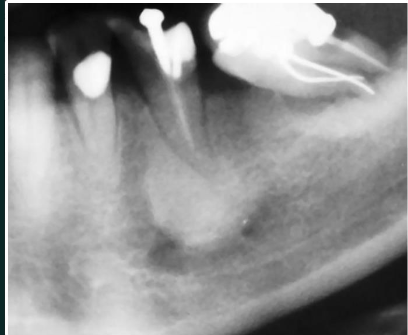 <p>RO lesion</p><p>RO at apex</p><p>linked with non vital tooth</p><p>no RL halo&nbsp;</p>