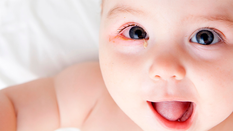 <p>(noun)</p><p>a watery fluid that collects in or drips from the nose or eyes</p><p>Word Associations: Eye Boogers and Discharge </p>